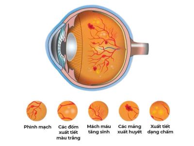 👁️NGUY CƠ MÙ LOÀ DO BỆNH ĐÁI THÁO ĐƯỜNG